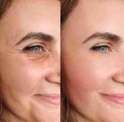 Botox Injection