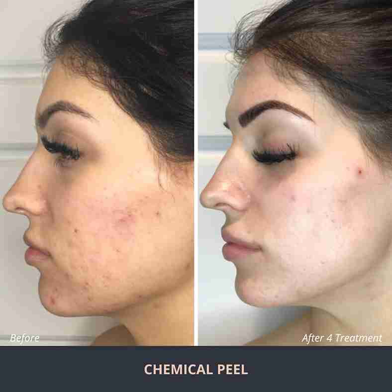 Chemical Peel Procedure