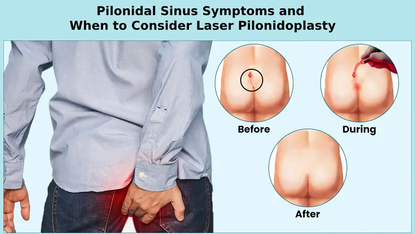 Pilonidal Sinus Surgery
